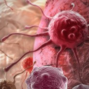 Día Mundial del Cáncer. Las cifras del cáncer en España