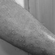 Asocian psoriasis con obesidad y diabetes tipo 2