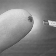 España es tras Estados Unidos el país con más amputaciones de miembros inferiores por diabetes tipo 2